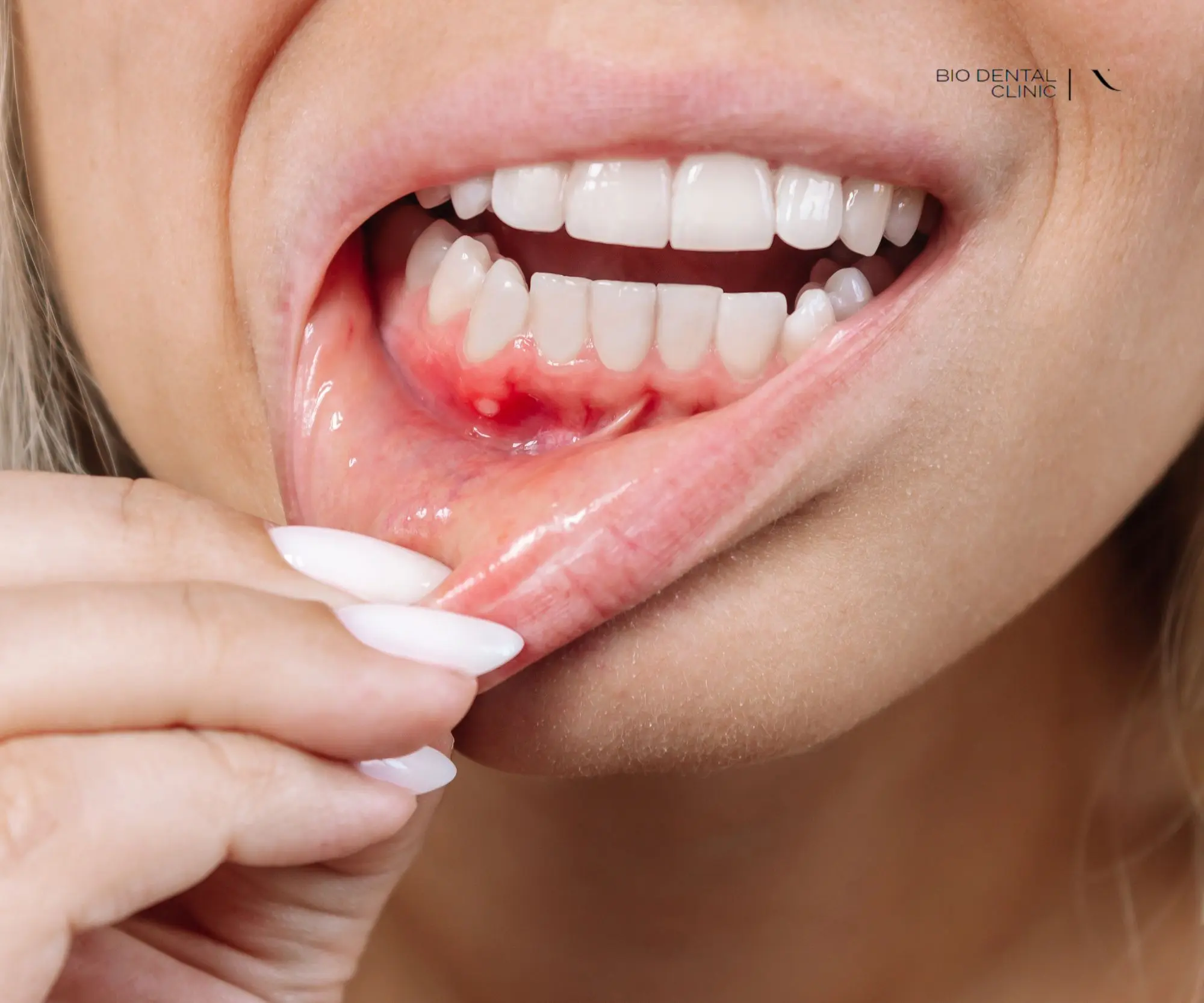 Pierwsze objawy chorób dziąseł, których nie możesz ignorować – BioDental